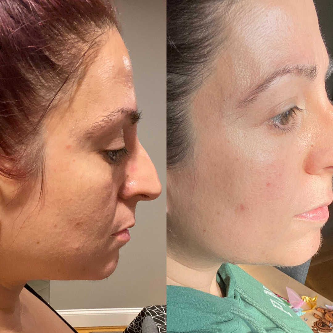 Before and after using Algae Retinol Face Oil