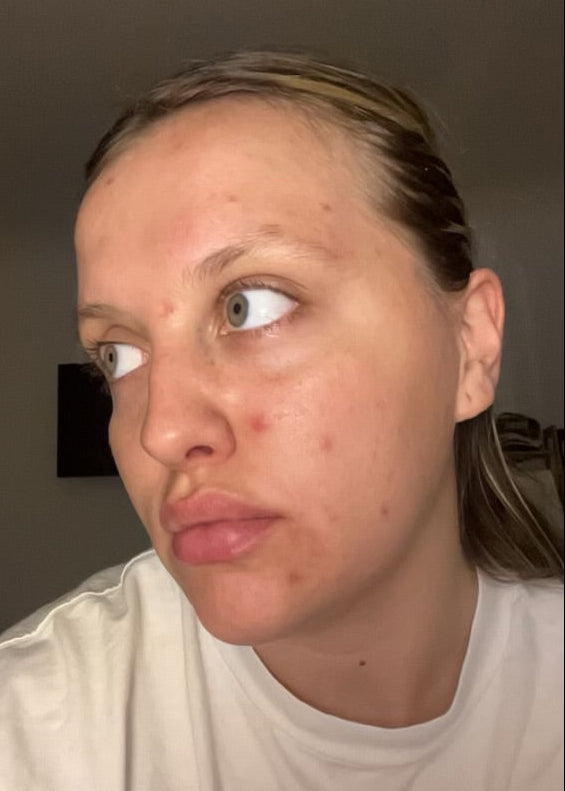 Person wearing a white shirt with a neutral background before Clear Skin Mineral Milk