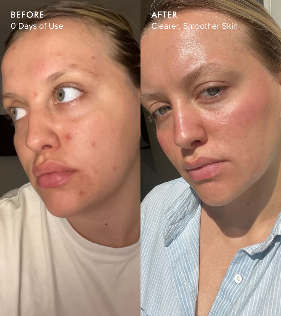 Clear Skin Mineral Milk before and after comparison of a person's face with clearer, smoother skin.