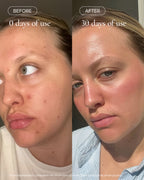 Before and after using MARA Clear Skin Mineral Milk
