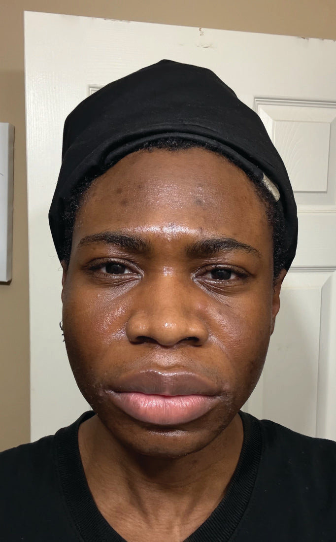 Person before using Aura Cleanse Foaming Gel Cleanser