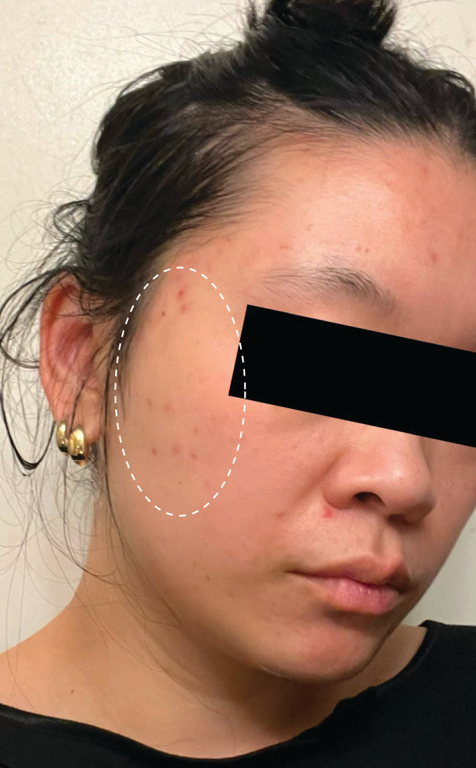 Person before using Aura Cleanse Foaming Gel Cleanser