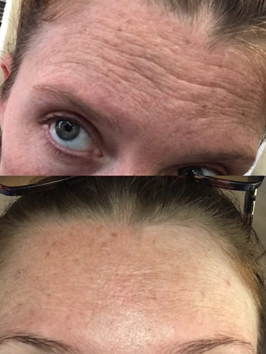Before and After Using Algae Retinol Face oil